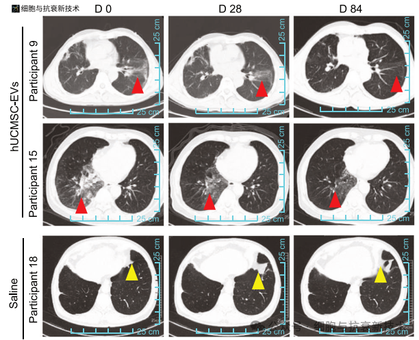 纖維化進程逆轉(zhuǎn)